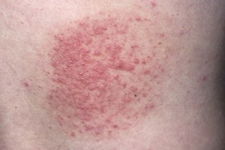 Polymorphic light eruption on white skin. There are lots of small, raised, red spots grouped together.